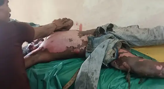 उरगा- breaking news – कोयला निकालते वक्त मजदूर हाई वोल्टेज तार की चपेट में, हालत नाज़ुक 